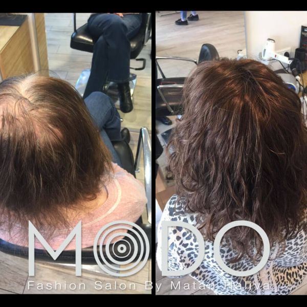 לפני ואחרי מילוי שיער דליל